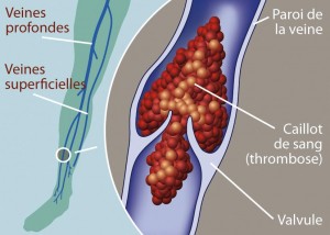 risque de thrombose