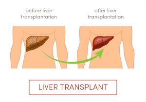 Liver transplantation